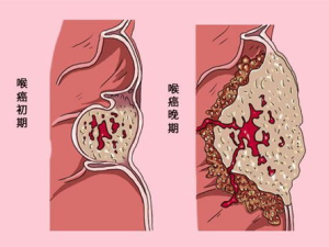 咽喉炎的早期症状,全面解析常见症状与预防措施”
