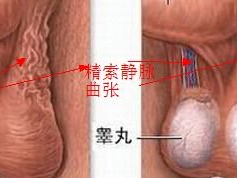 精索静脉曲张的症状,男性阴囊不适与不育的警示